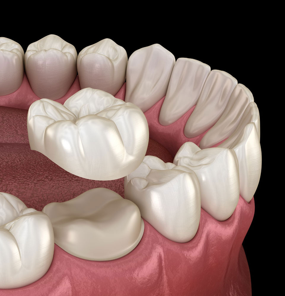 dental crown 3d model