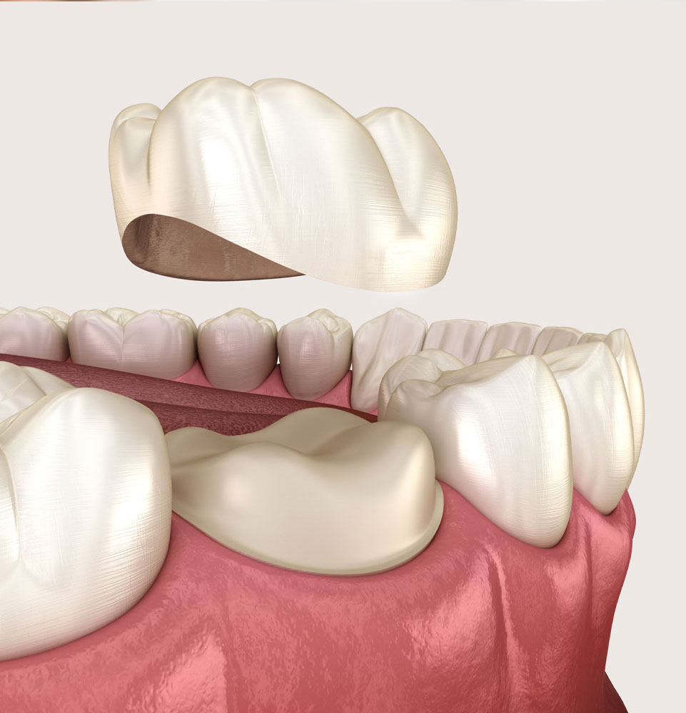 dental crown 3d model