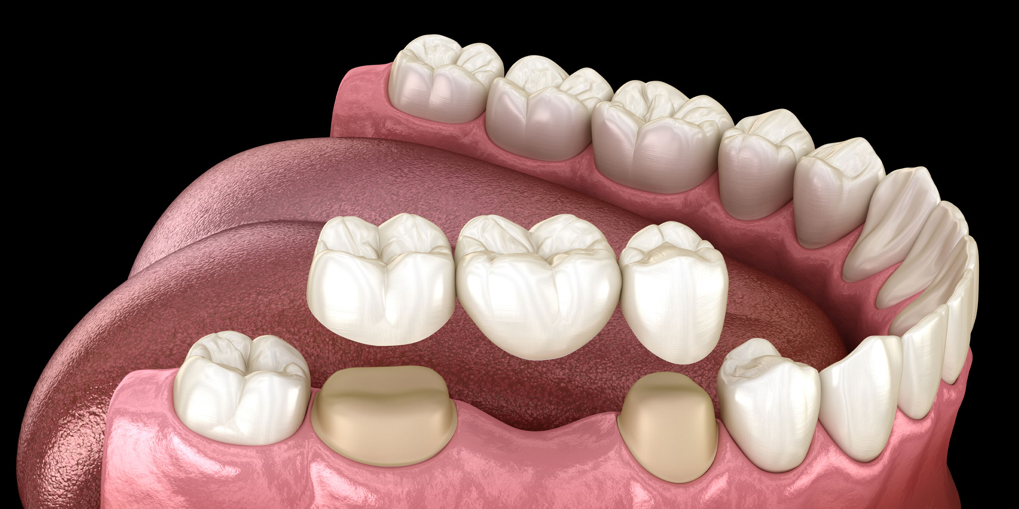 dental crown for missing tooth 3d model