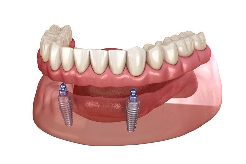implant supported denture 3d model digital rendering