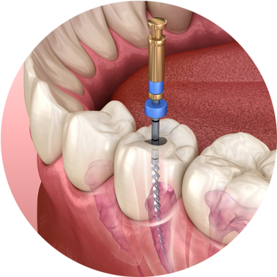 root canal procedure apicoectomy 3d model