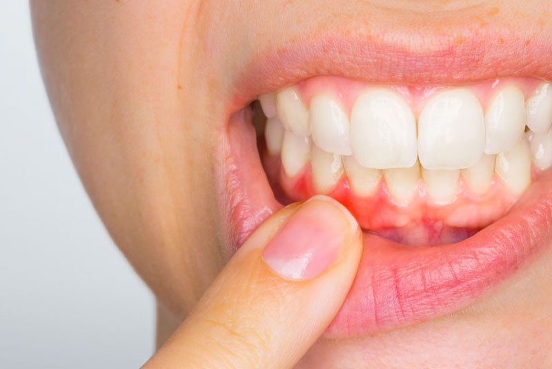 gum disease being shown on gums